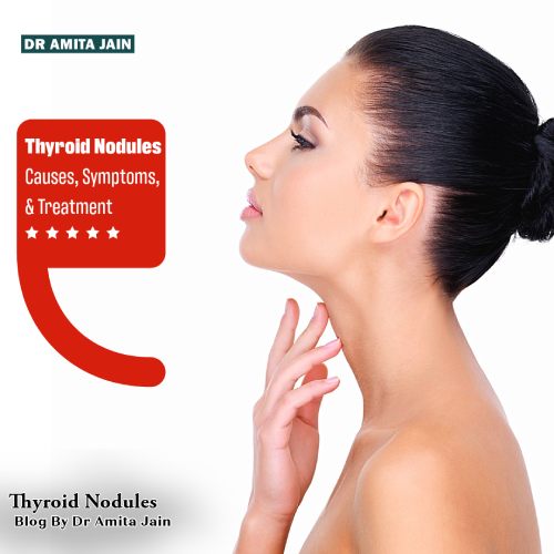 Dr Amita Jain, who is a leading thyroid surgeon in the field of laparoscopic surgery in India shares what is thyroid nodules, causes, Symptoms, and Treatment