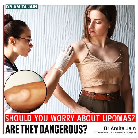 Should You Worry About Lipomas? Are they Dangerous?