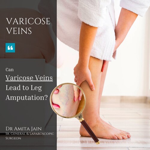 Dr Amita Jain who is one of the best surgeons and specialists for varicose veins in Delhi and India.