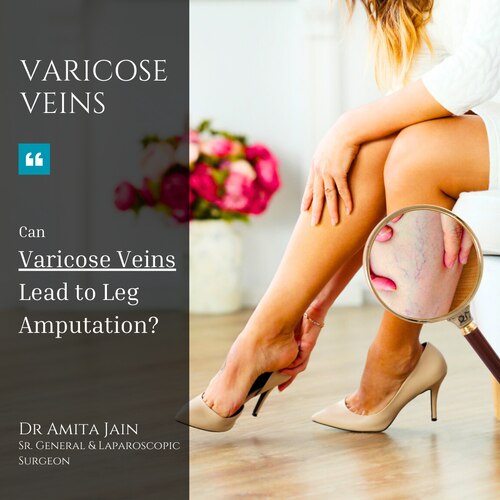 best varicose vein doctor in Delhi Dr Amita Jain