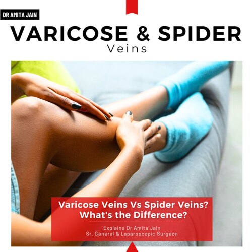 vericose veins and spider veins