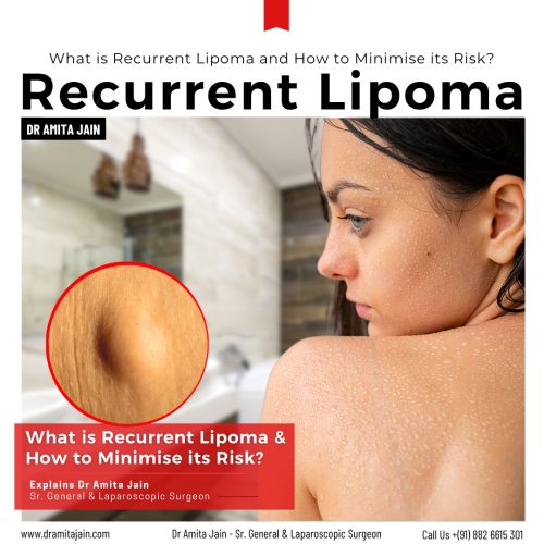Lipoma treatment by Dr Amita Jain