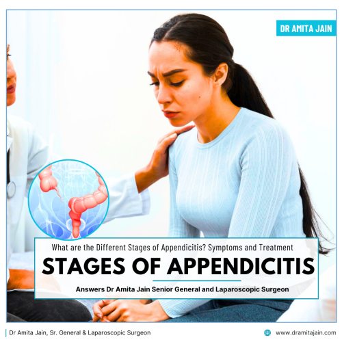 best surgeon for appendicitis in Delhi